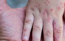 Maymun çiçeği virüsünde deri döküntüsü ve kas ağrıları görülüyor