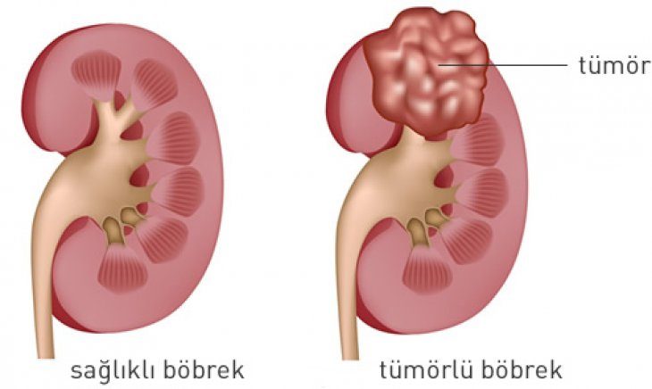Her böbrek tümörü kanser değildir!